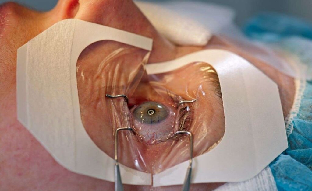 Cataract Surgery