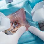 LASIK Surgery