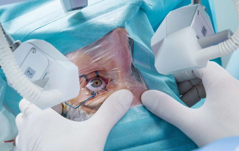 LASIK Surgery